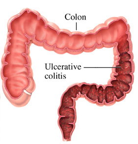 التهاب القولون التقرحي Ulcerative Colitis