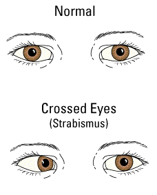 الحول | حول Strabismus | Crossed Eyes