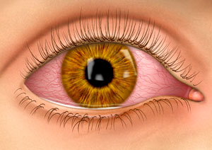 الرمد | احمرار العين | العين الحمراء Pink eye - Conjunctivitis