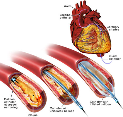 العلاج بالبالون والقثطار | رأب الوعاء التاجي Balloon Angioplasty