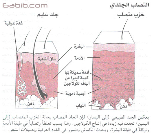 تصلب الجلد | الخزب المتصلب Scleroderma