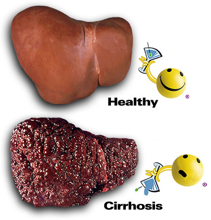 التليف الكبدي Cirrhosis