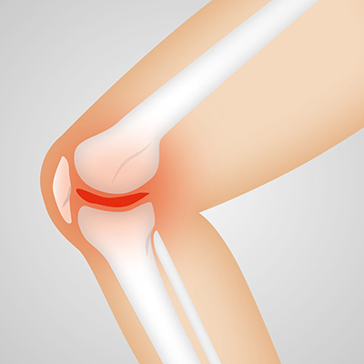 خشونة المفاصل Osteoarthritis