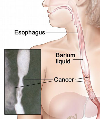 سرطان المريء Esophageal cancer