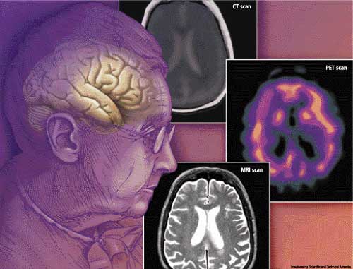 الخرف | العته Dementia