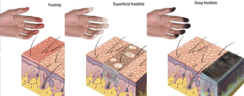 عضة الصقيع Frostbite