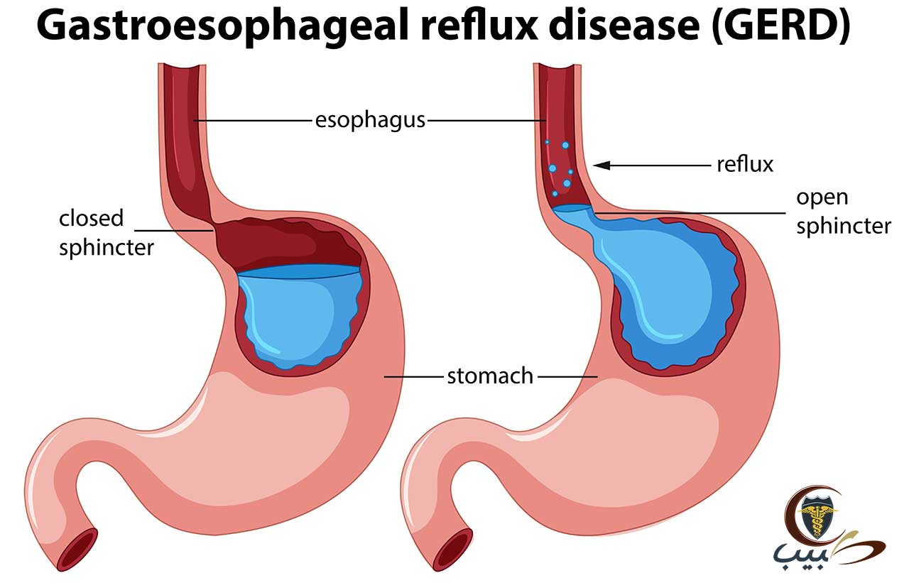 علاج الارتجاع المعدي المريئي بالمنزل