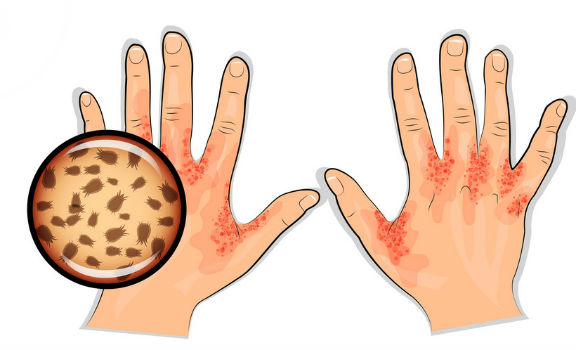 علاج الجرب Scabies