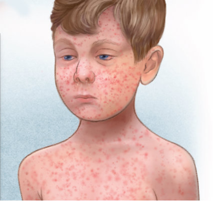 الحصبة Measles