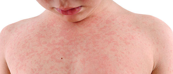 علاج الحصبة الالمانية | الاعراض وخطر الاصابة German Measles