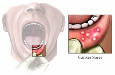 قرحة الفم الآكلة