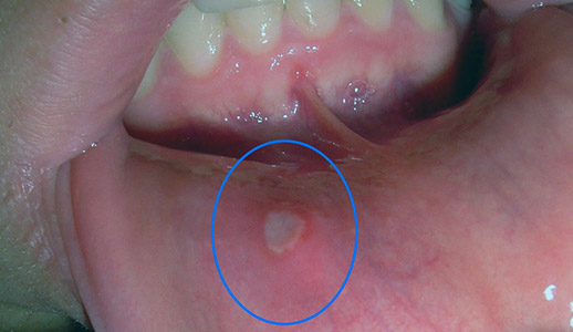 قرحة الفم وكيفية العلاج Oral Ulcer