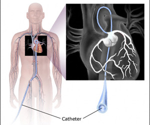 قسطرة القلب | التمييل Cardiac Catheterization