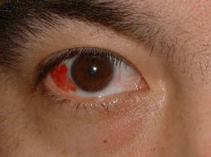 نزيف تحت ملتحمة العين Subconjunctival hemorrhage bleed