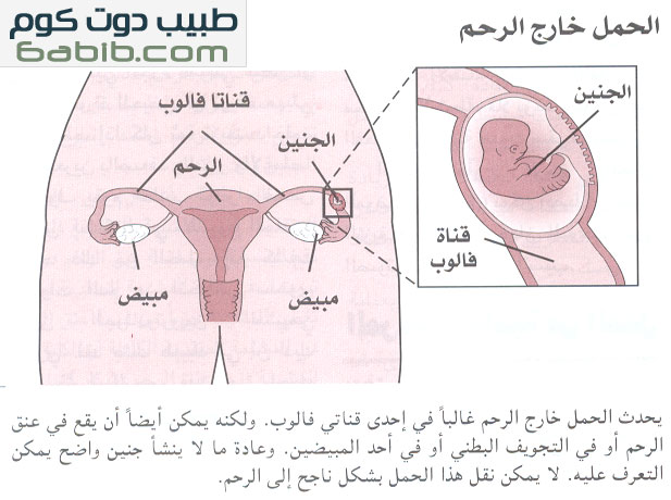 الحمل خارج الرحم Ectopic Pregnancy