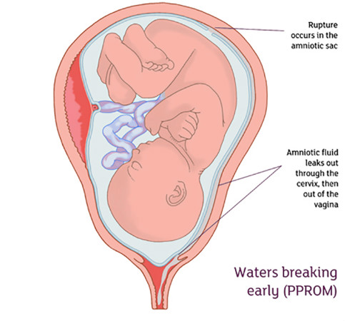 التمزق المبكر للأغشية الجنينية Premature Rupture of Membranes