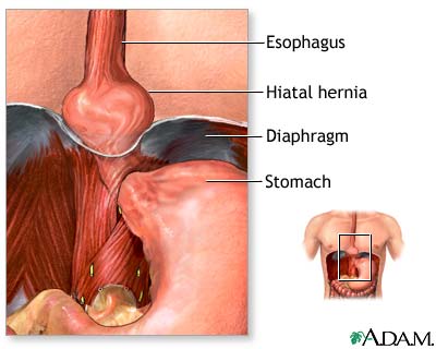 ‏التهاب المريء inflammation of esophagus