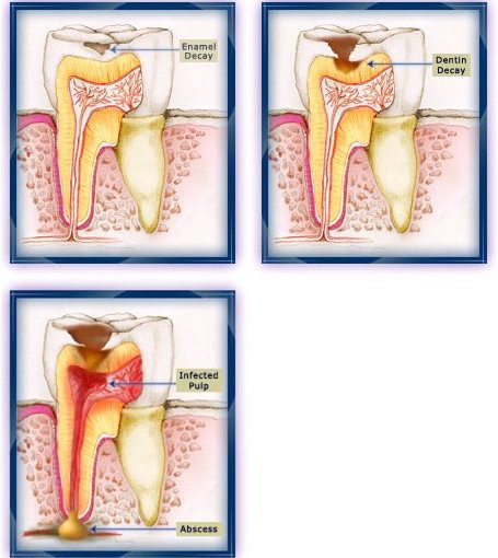 تسوس الأسنان Tooth Decay