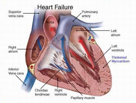 قصور القلب | مرض خطير صامت