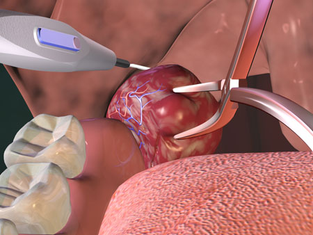 عملية استئصال اللوزتين Tonsillectomy