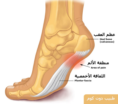 الم العقب ، ألم عظم كعب القدم Heel pain