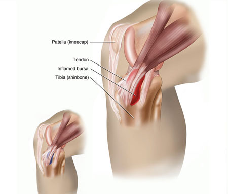 ‏التهاب الكيس الزلالي، التهاب الجراب Bursitis