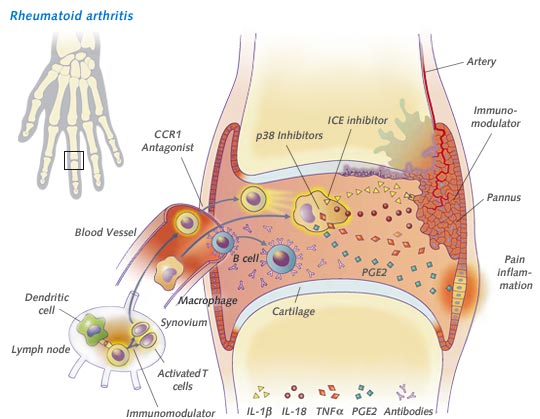 ‏علاج التهاب المفاصل في المنزل Arthritis