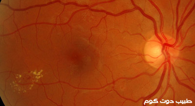 اعتلال الشبكية السكري Diabetic retinopathy | كيف يؤثر ارتفاع السكر في الدم على شبكية العين