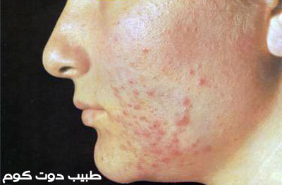 حب الشباب Acne