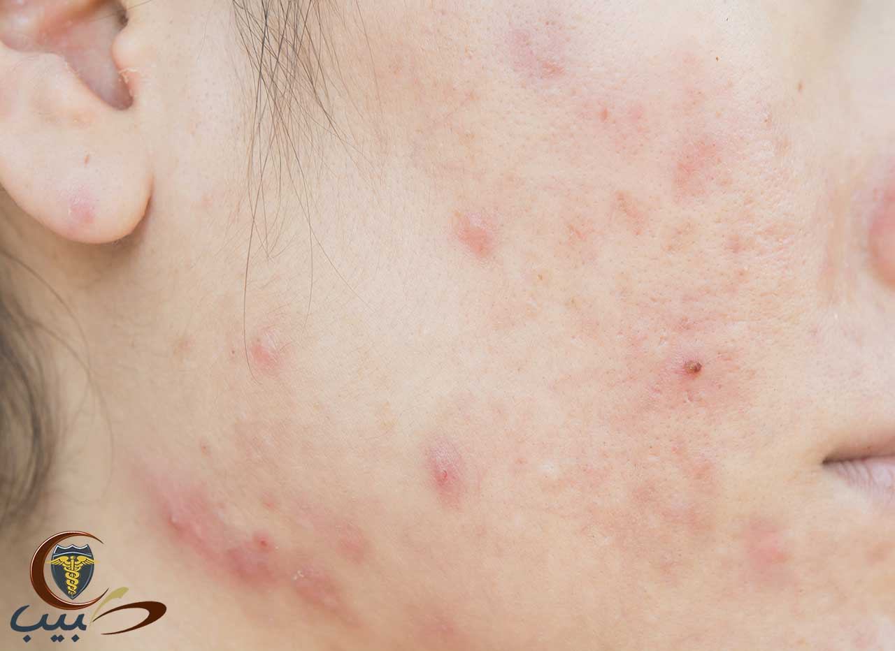 أدوية علاج حب الشباب Acne