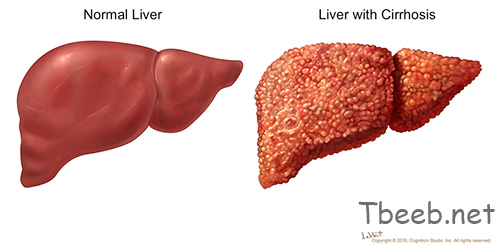 تشمع الكبد Cirrhosis