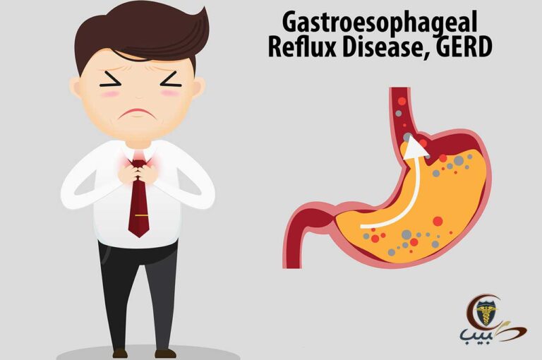 مرض الارتداد المعدي المريئي GERD