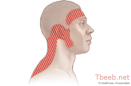 صداع التوتر Tension headache