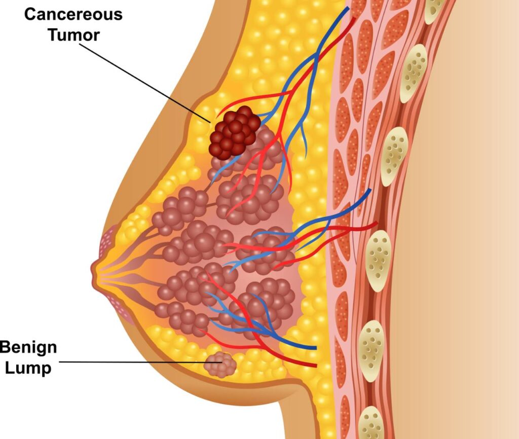 سرطان الثدي
