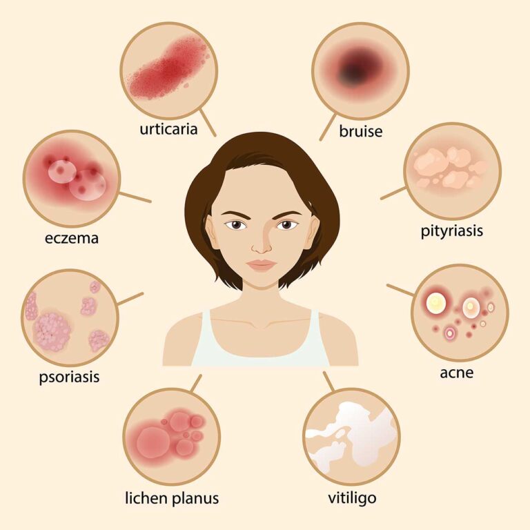 حب الشباب في الحمل Pregnancy Acne