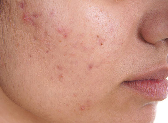 حب الشباب في الحمل acne