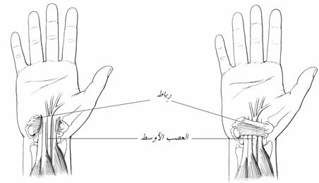 تناذر النفق الرسغي | العناية الذاتية