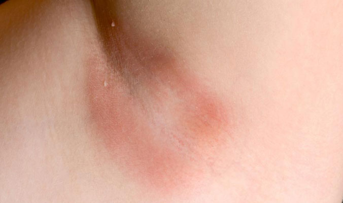 تشخيص وعلاج داء الكانديدا أو المبيضات Candidiasis