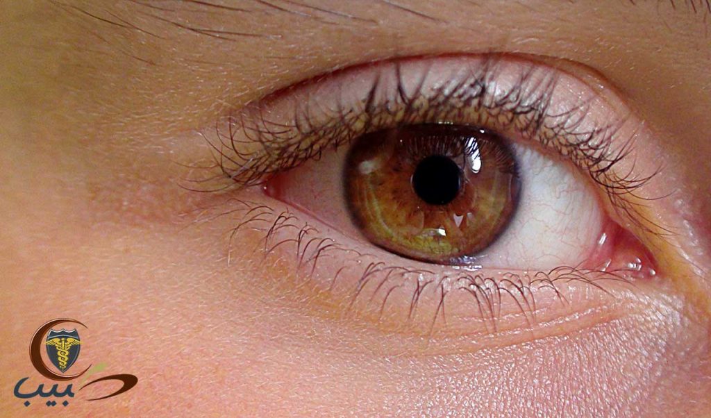 اسباب اللون الاسود تحت العين عند الاطفال - Allawn