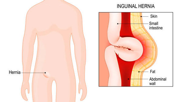 فتق Hernia