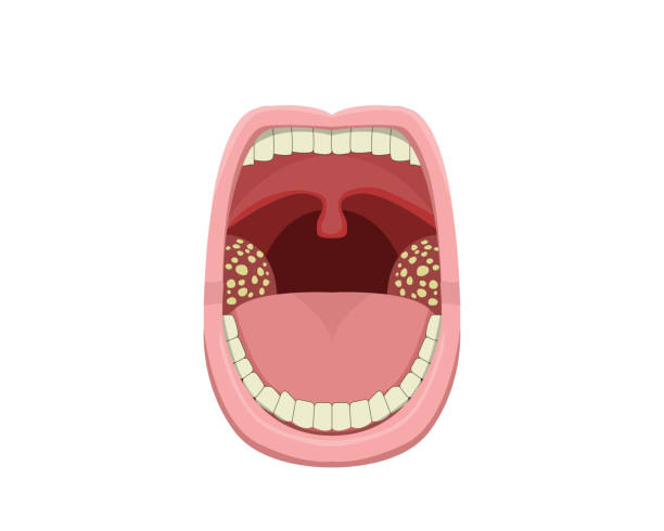 التهاب اللوزتين Tonsillitis | نبذة مختصرة