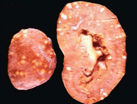 التدرن أو السل الكلوي Renal tuberculosis