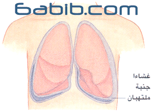 التهاب الجنبة | ذات الجنب Pleurisy | Pleuritis