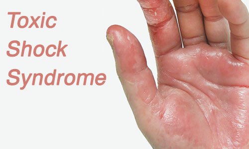 متلازمة الصدمة التسممية Toxic Shock Syndrome
