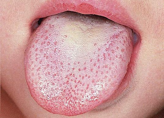 علاج داء المبيضات Candidiasis