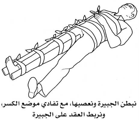 كسور الورك والساق