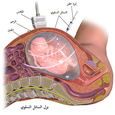 بزل السلى أو بزل السائل الأمنيوسي Amniocentesis