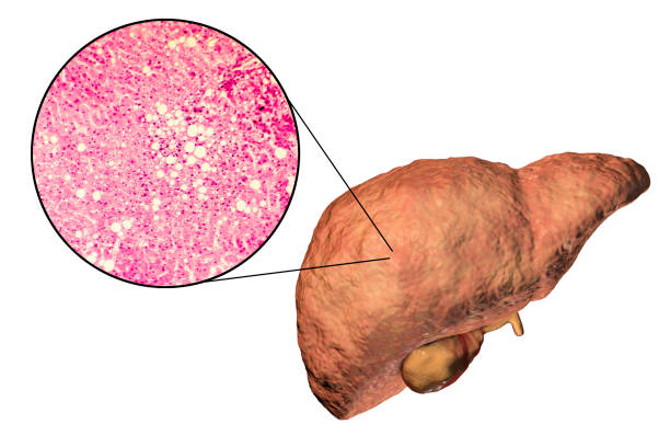 الكبد الدهنية Fatty Liver | ما هي؟