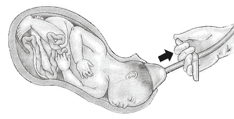 الولادة بالشفط vacuum extraction