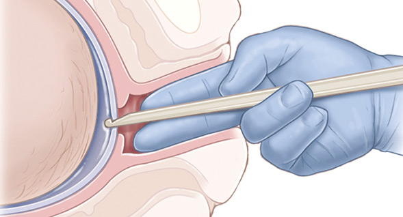 تمزيق الطبيب للكيس الأمينوسي للجنين Artificial Rupture of Membranes